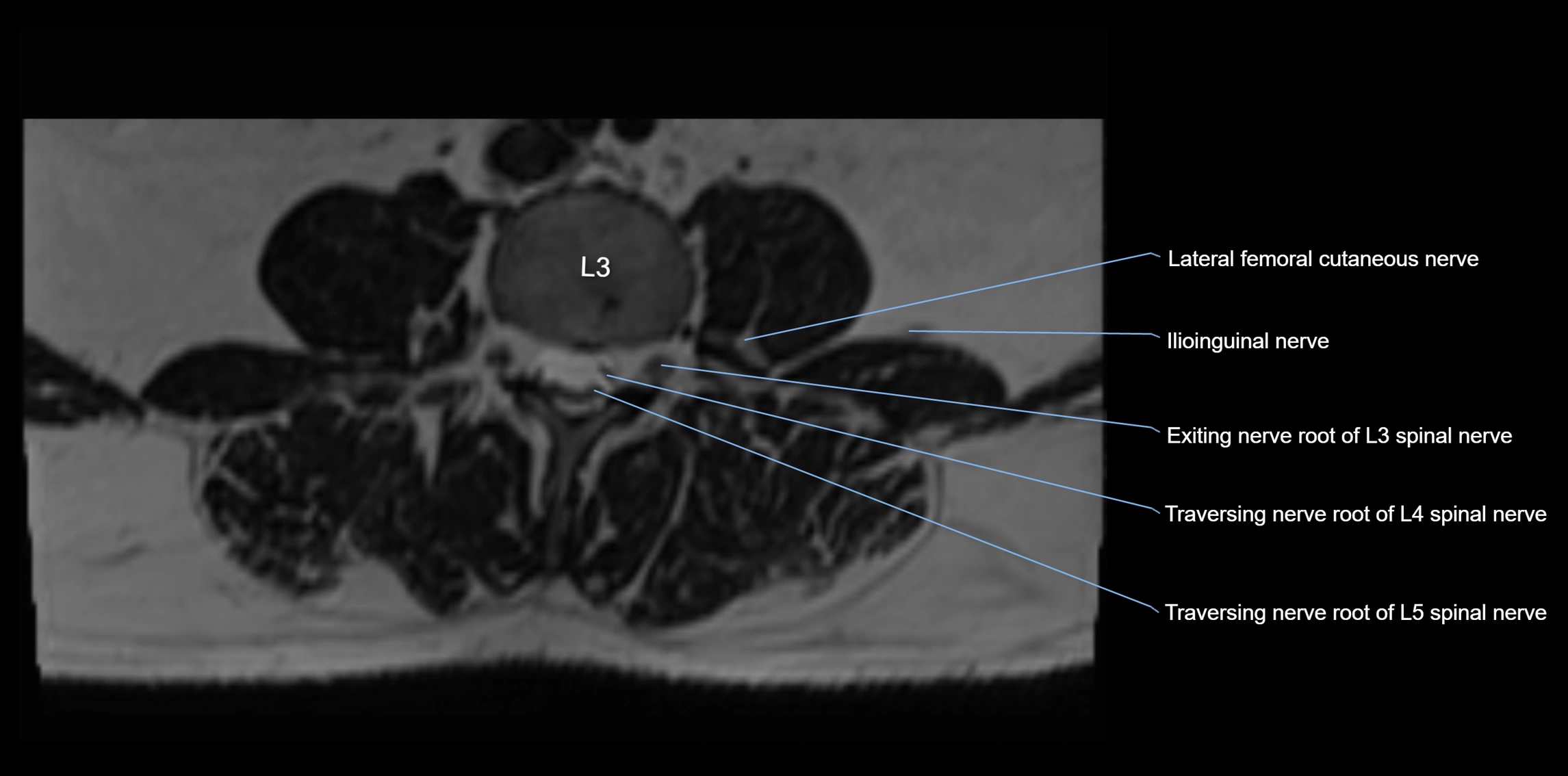 MR lumbosacral plexus axial cross sectional anatomy 3T  radiology  image-img-1008001-00025.webp